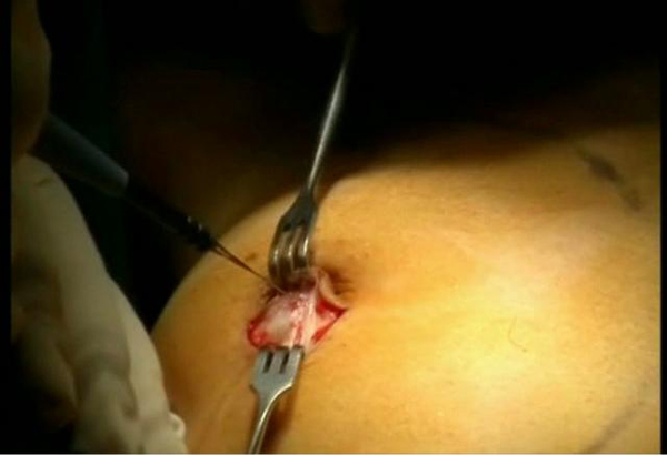 implantes de mamas